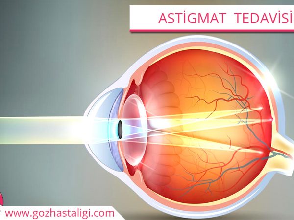 astigmat tedavisi, astigmat, astigmat göz, astigmat hastalığı,