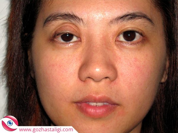 göz kapağı sarkması, hayko göz, göz kapağı düşüklüğü,